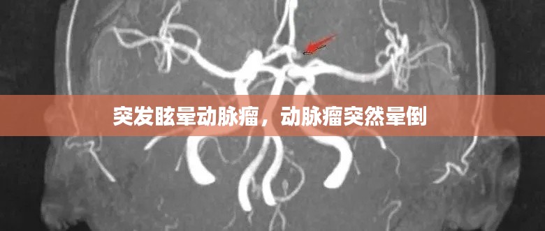 突发眩晕动脉瘤，动脉瘤突然晕倒 