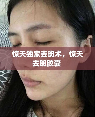 惊天独家去斑术，惊天去斑胶囊 